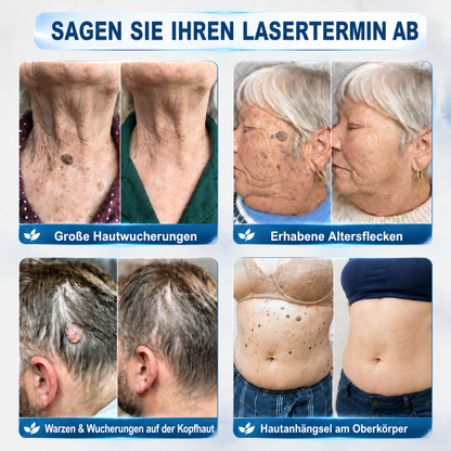 𝐇𝐈𝐒𝐊𝐈𝐍®👩‍⚕️ 𝟕-𝐓𝐚𝐠𝐞-𝐇𝐚𝐮𝐭𝐚𝐧𝐡ä𝐧𝐠𝐬𝐞𝐥- & 𝐅𝐥𝐞𝐜𝐤𝐞𝐧𝐞𝐧𝐭𝐟𝐞𝐫𝐧𝐞𝐫 – 𝐅𝐨𝐫𝐭𝐬𝐜𝐡𝐫𝐢𝐭𝐭𝐥𝐢𝐜𝐡𝐞𝐫 𝐑𝐨𝐥𝐥-𝐨𝐧-𝐒𝐭𝐢𝐟𝐭 𝐳𝐮𝐫 𝐬𝐜𝐡𝐦𝐞𝐫𝐳𝐟𝐫𝐞𝐢𝐞𝐧 𝐮𝐧𝐝 𝐧𝐚𝐫𝐛𝐞𝐧𝐟𝐫𝐞𝐢𝐞𝐧 𝐄𝐧𝐭𝐟𝐞𝐫𝐧𝐮𝐧𝐠 𝐯𝐨𝐧 𝐇𝐚𝐮𝐭𝐮𝐧𝐫𝐞𝐢𝐧𝐡𝐞𝐢𝐭𝐞𝐧