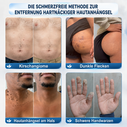 𝐇𝐈𝐒𝐊𝐈𝐍®👩‍⚕️ 𝟕-𝐓𝐚𝐠𝐞-𝐇𝐚𝐮𝐭𝐚𝐧𝐡ä𝐧𝐠𝐬𝐞𝐥- & 𝐅𝐥𝐞𝐜𝐤𝐞𝐧𝐞𝐧𝐭𝐟𝐞𝐫𝐧𝐞𝐫 – 𝐅𝐨𝐫𝐭𝐬𝐜𝐡𝐫𝐢𝐭𝐭𝐥𝐢𝐜𝐡𝐞𝐫 𝐑𝐨𝐥𝐥-𝐨𝐧-𝐒𝐭𝐢𝐟𝐭 𝐳𝐮𝐫 𝐬𝐜𝐡𝐦𝐞𝐫𝐳𝐟𝐫𝐞𝐢𝐞𝐧 𝐮𝐧𝐝 𝐧𝐚𝐫𝐛𝐞𝐧𝐟𝐫𝐞𝐢𝐞𝐧 𝐄𝐧𝐭𝐟𝐞𝐫𝐧𝐮𝐧𝐠 𝐯𝐨𝐧 𝐇𝐚𝐮𝐭𝐮𝐧𝐫𝐞𝐢𝐧𝐡𝐞𝐢𝐭𝐞𝐧