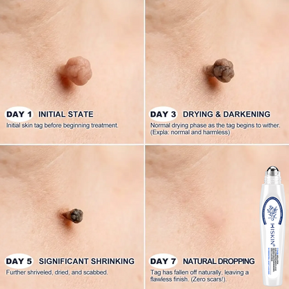 𝐇𝐈𝐒𝐊𝐈𝐍®👩‍⚕️ 𝟕-𝐓𝐚𝐠𝐞-𝐇𝐚𝐮𝐭𝐚𝐧𝐡ä𝐧𝐠𝐬𝐞𝐥- & 𝐅𝐥𝐞𝐜𝐤𝐞𝐧𝐞𝐧𝐭𝐟𝐞𝐫𝐧𝐞𝐫 – 𝐅𝐨𝐫𝐭𝐬𝐜𝐡𝐫𝐢𝐭𝐭𝐥𝐢𝐜𝐡𝐞𝐫 𝐑𝐨𝐥𝐥-𝐨𝐧-𝐒𝐭𝐢𝐟𝐭 𝐳𝐮𝐫 𝐬𝐜𝐡𝐦𝐞𝐫𝐳𝐟𝐫𝐞𝐢𝐞𝐧 𝐮𝐧𝐝 𝐧𝐚𝐫𝐛𝐞𝐧𝐟𝐫𝐞𝐢𝐞𝐧 𝐄𝐧𝐭𝐟𝐞𝐫𝐧𝐮𝐧𝐠 𝐯𝐨𝐧 𝐇𝐚𝐮𝐭𝐮𝐧𝐫𝐞𝐢𝐧𝐡𝐞𝐢𝐭𝐞𝐧